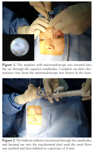 Surgical Technique And Preliminary Results Of Transcanalicular