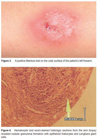 Lupus Vulgaris Of The Ocular Adnexa – Philippine Journal Of Ophthalmology