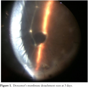 Descemet’s Membrane Detachment in a Corneal Graft After Removal of a ...